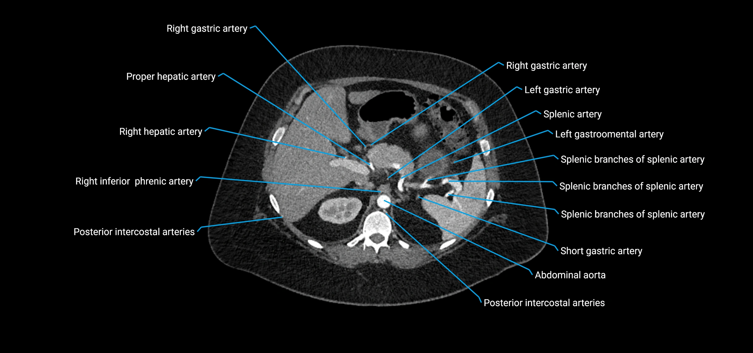 CTA abdomen axial cross sectional anatomy labelled image_48 (2).webp